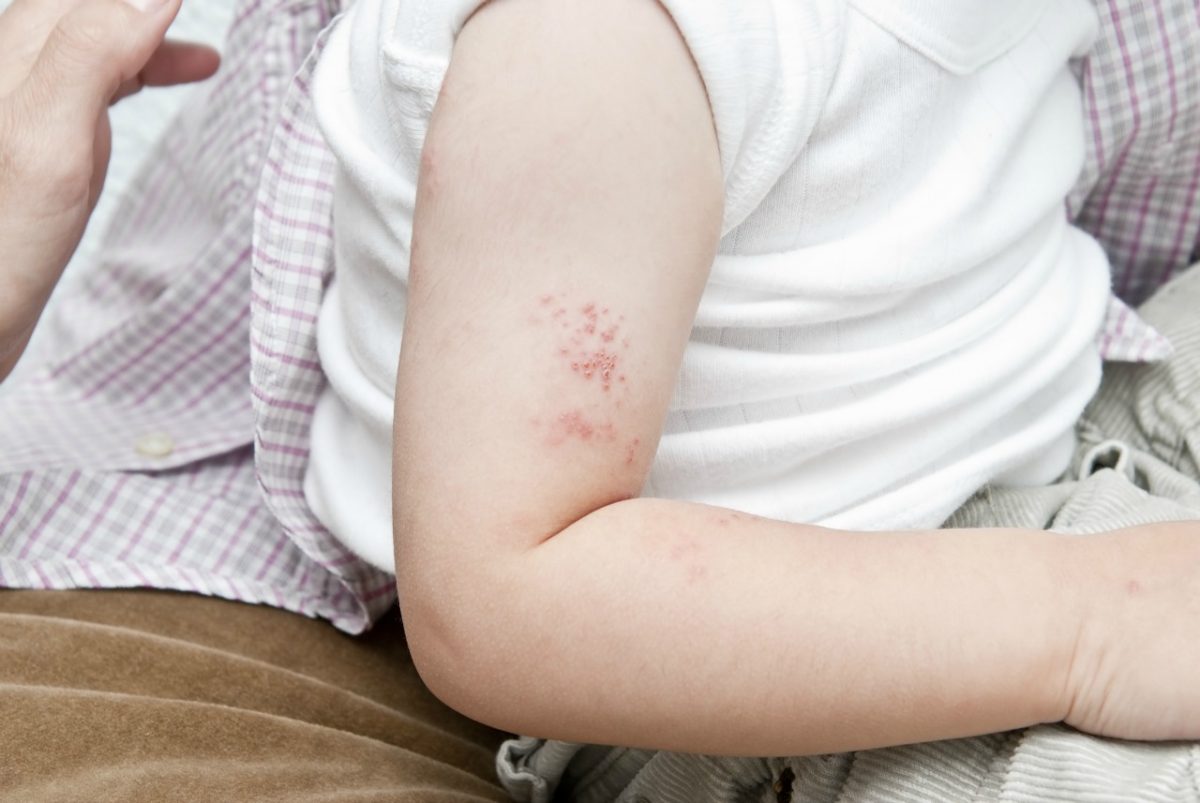 Herpes zoster virus, shingles, on baby's arm