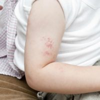 Herpes zoster virus, shingles, on baby's arm